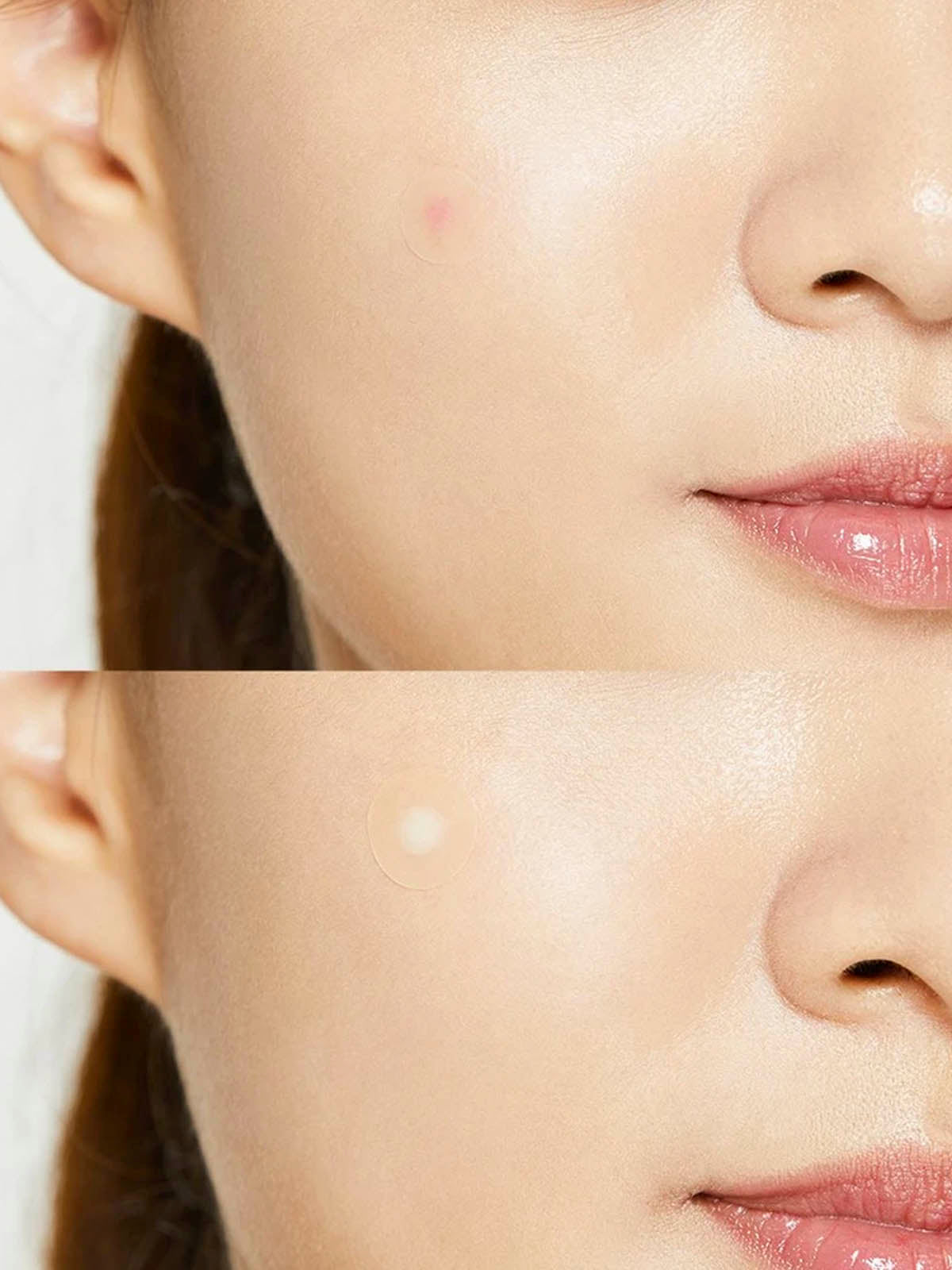 Acne Pimple Master Patch